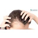 افضل علاج لتساقط الشعر