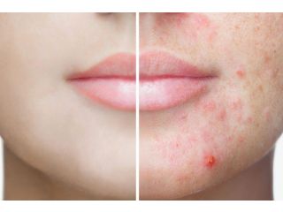 أسباب ظهور حب الشباب